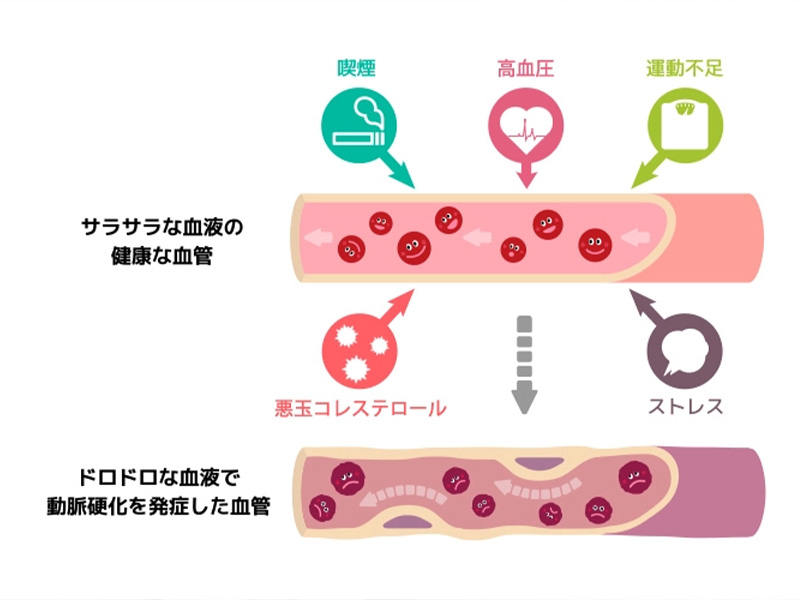 動脈硬化の診療